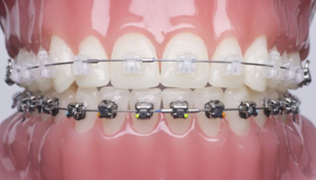 Damon-Spange mit zahnfarbenen Brackets 